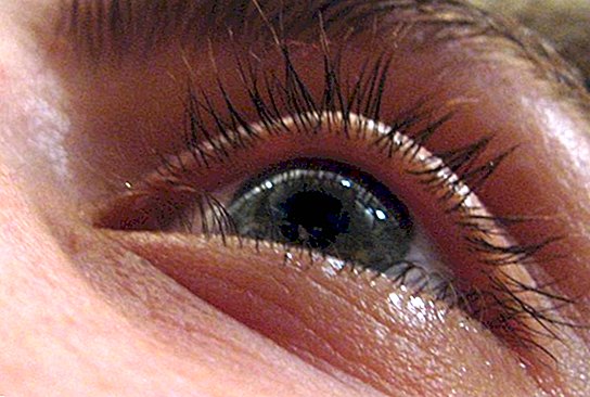 Опухлі очі - Як лікувати опухлі очі?