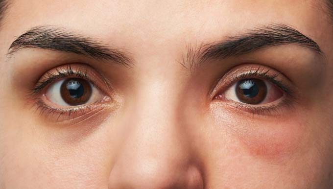Опухлі очі - Як лікувати опухлі очі?