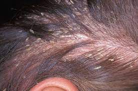 Шкіра голови - Які ознаки екземи шкіри голови?