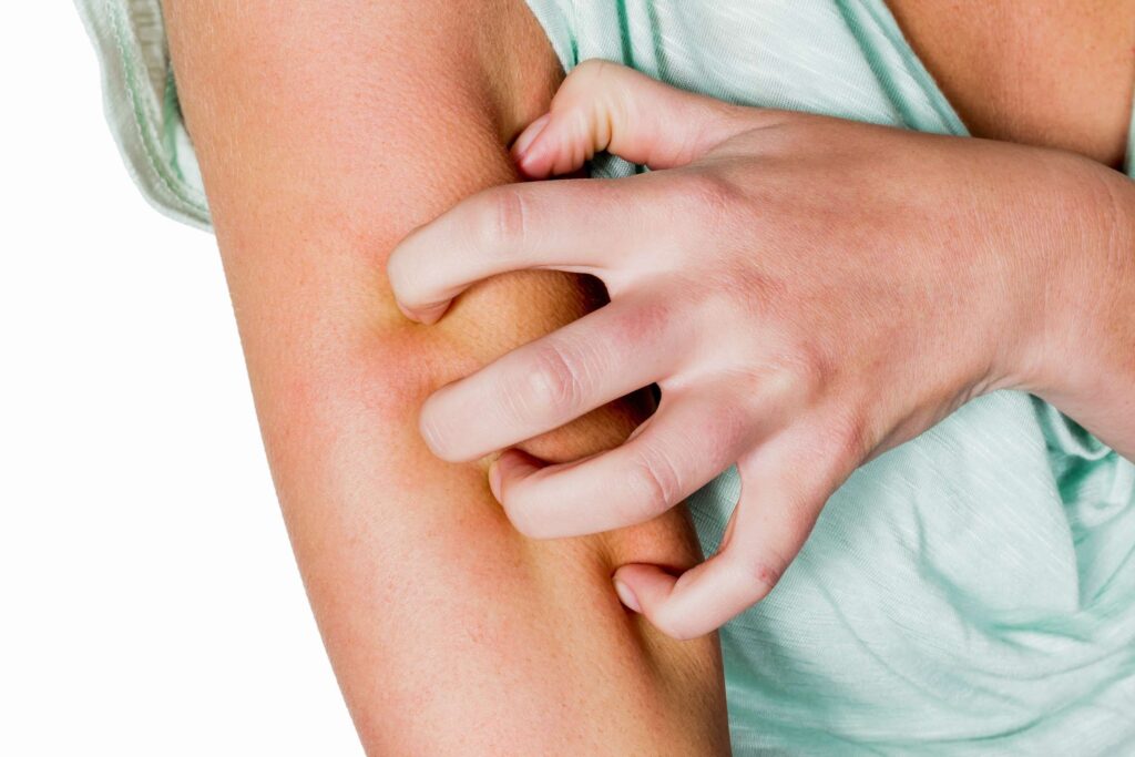 Запалення шкіри - Як лікувати запалення шкіри?