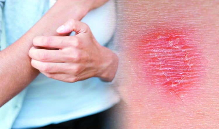Запалення шкіри - Як лікувати запалення шкіри?